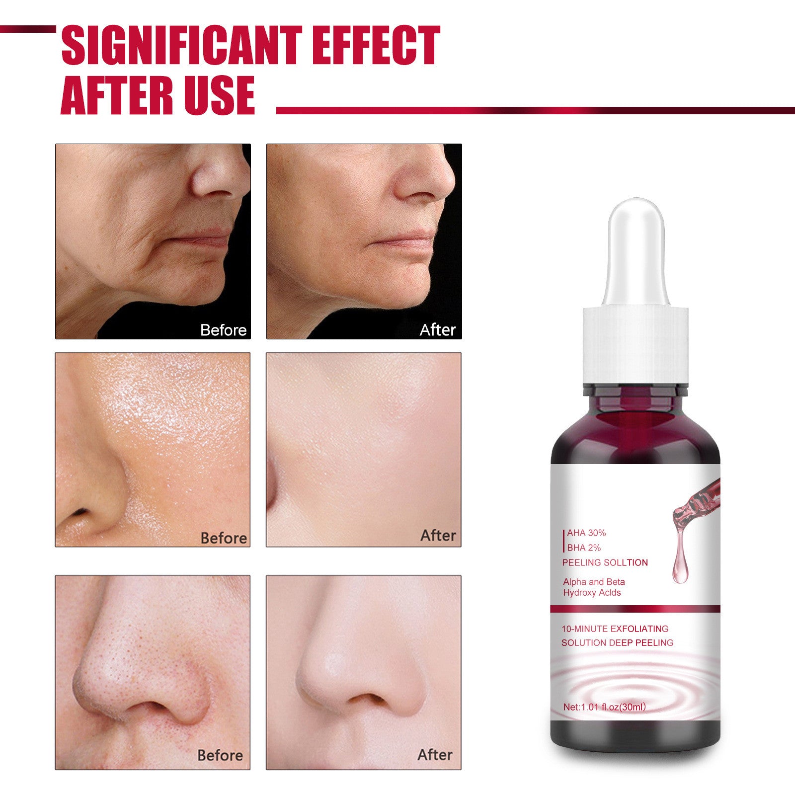 Salicylic Acid Acne Treatment Clear Skin Fast | Dermatology Grade