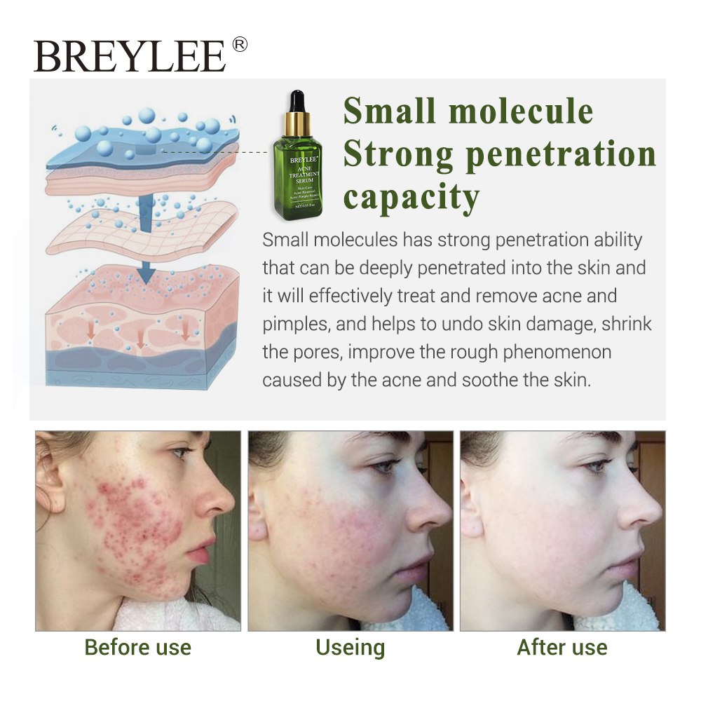 Acne Treatment Serum Fast Clear Skin | Visible Results in Days