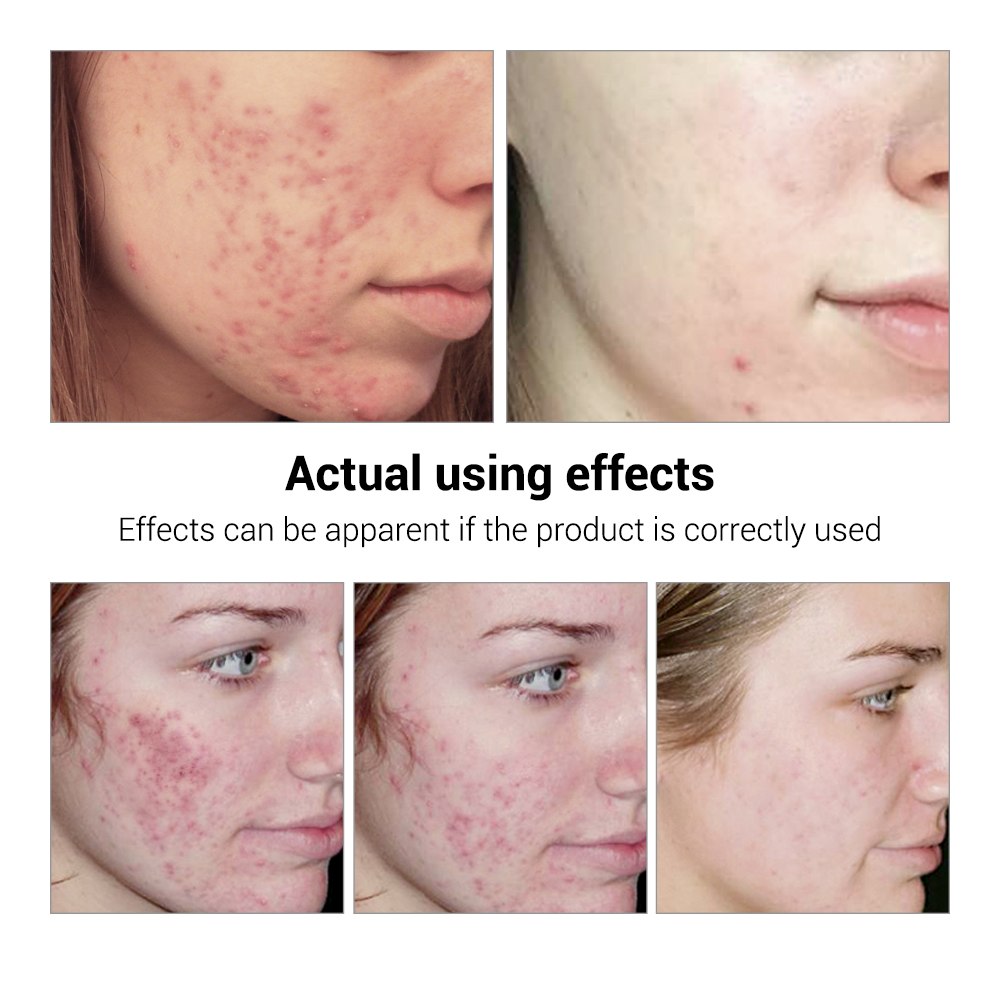 Acne Treatment Serum Fast Clear Skin | Visible Results in Days