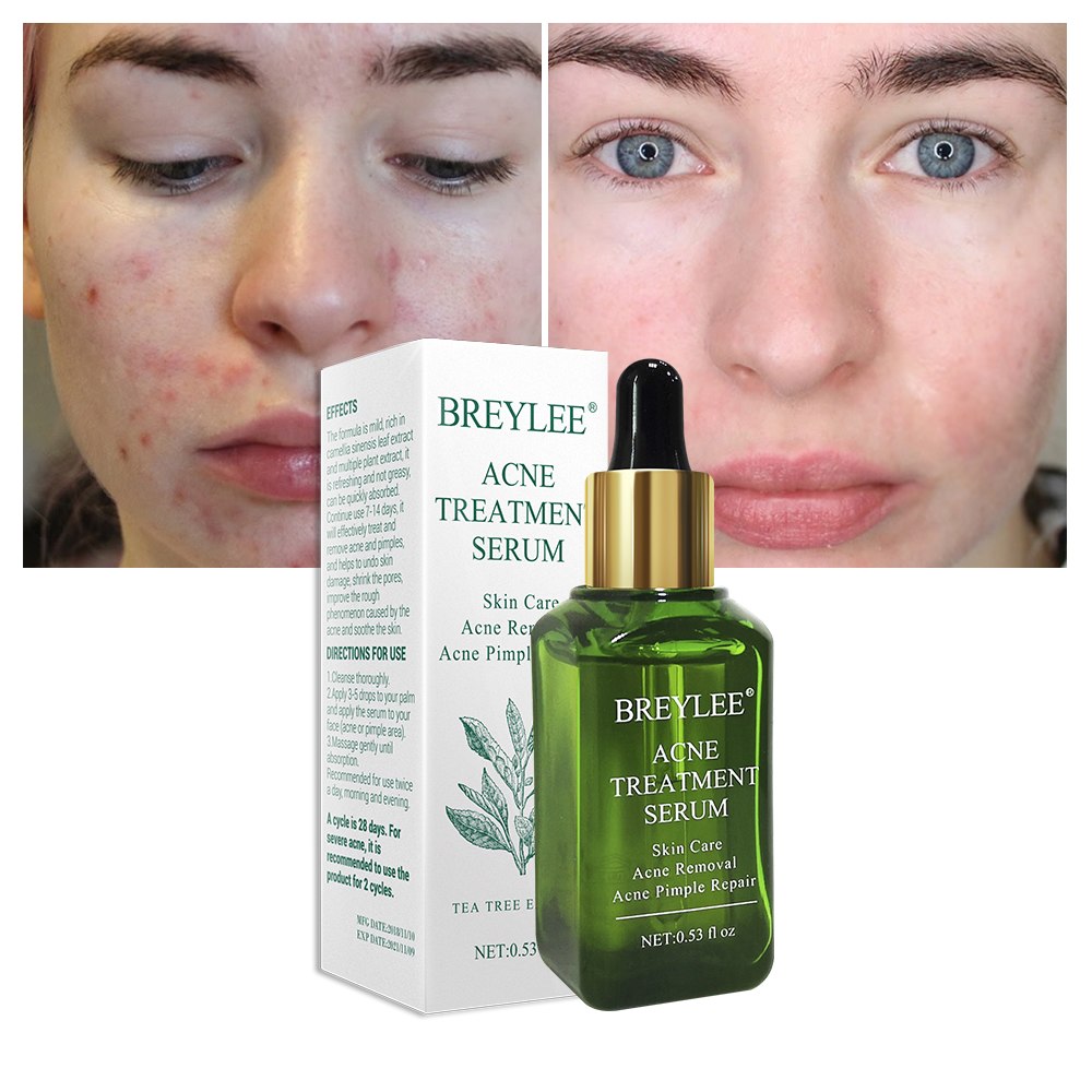 Acne Treatment Serum Fast Clear Skin | Visible Results in Days